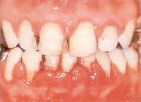 歯周病の歯肉