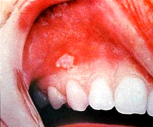 先天性歯（歯が余分にある）