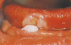 裏 舌 口内炎 原因 の 舌の裏側の口内炎が痛い･･･。口内炎の原因と治し方を経験談で語ります！