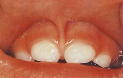 歯茎 白い 赤ちゃん 子どもの歯茎の腫れが気になったら小児歯科へ
